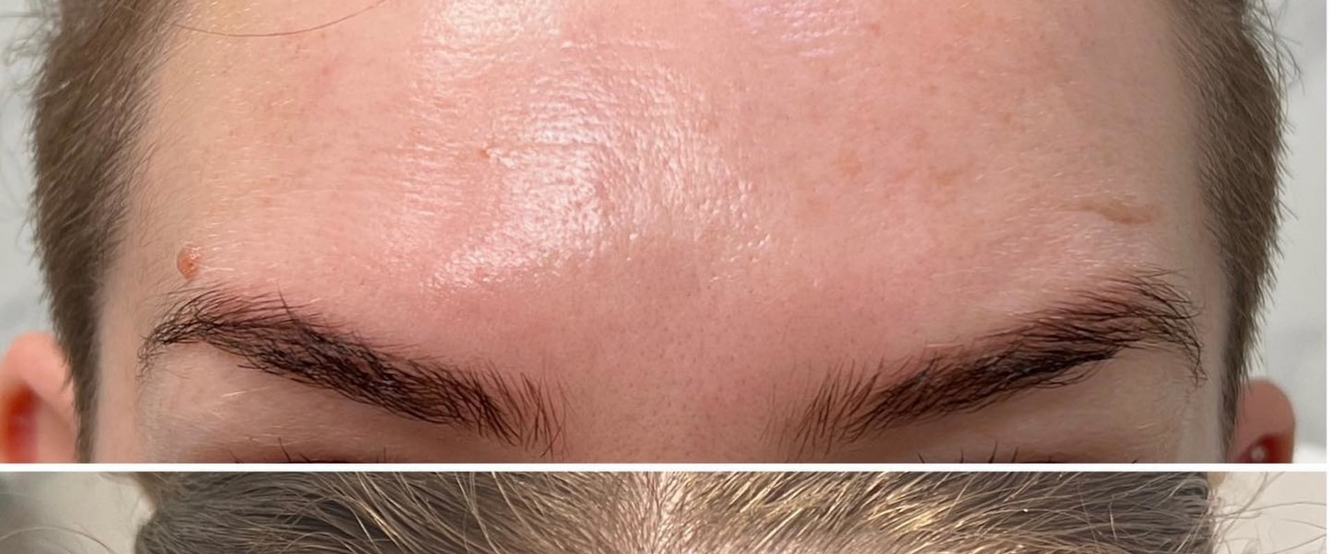 A Comprehensive Look at Botox Injections for Aesthetic Enhancement