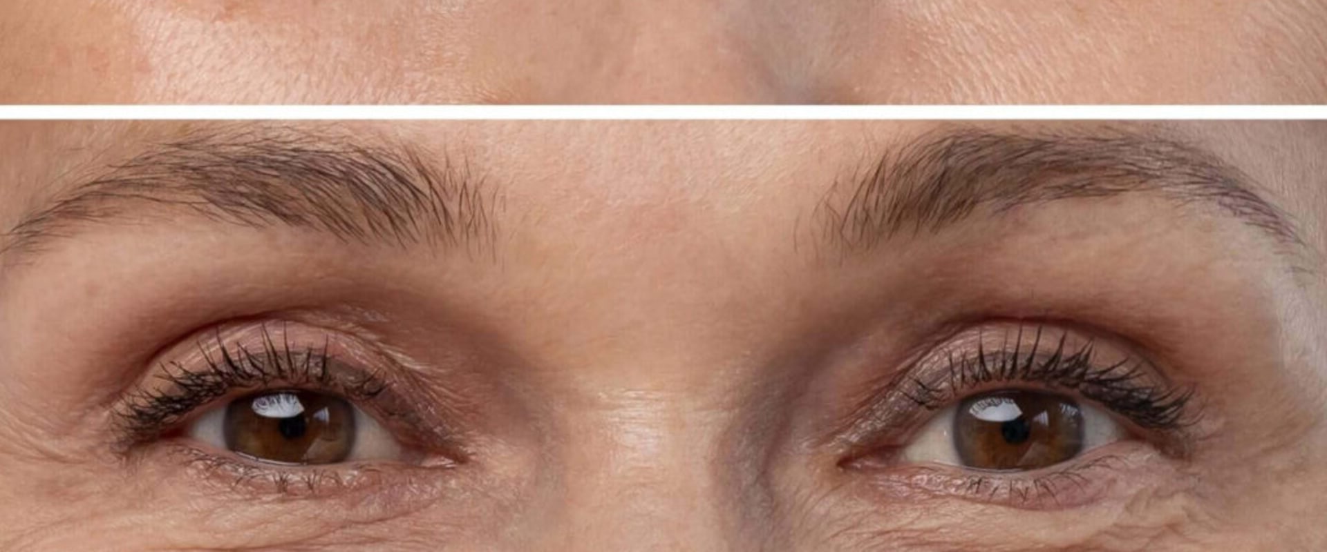 A Comprehensive Guide to Dermal Fillers: Enhance Your Facial Features