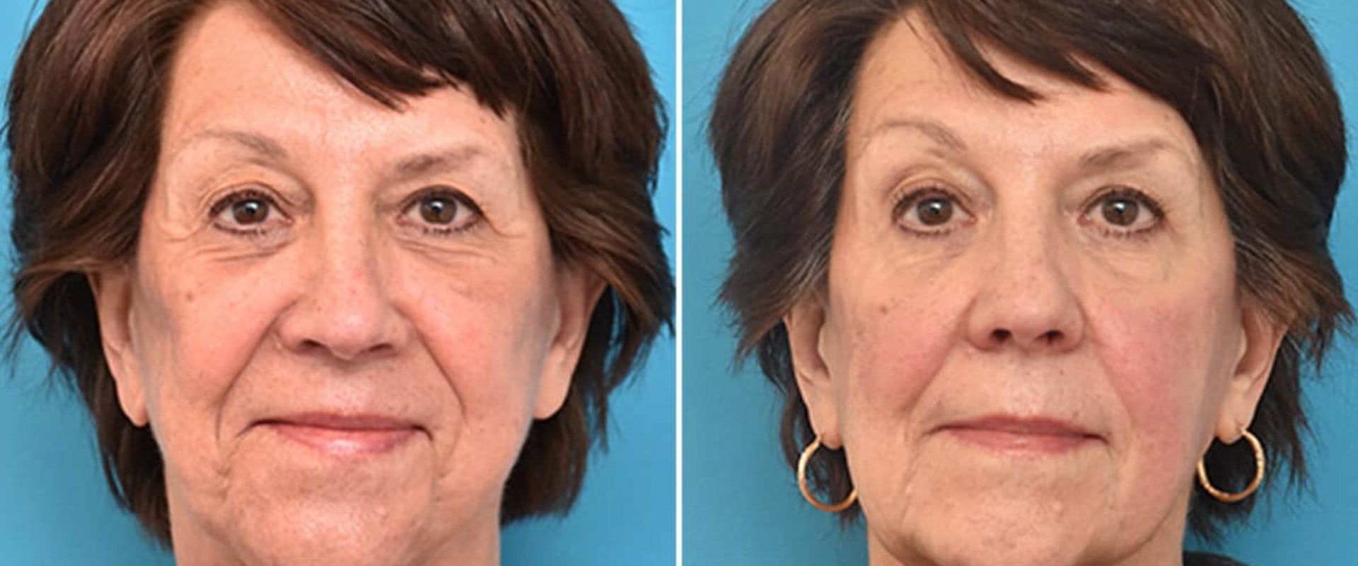 Facelift Surgery: The Ultimate Guide to Rejuvenating Your Look