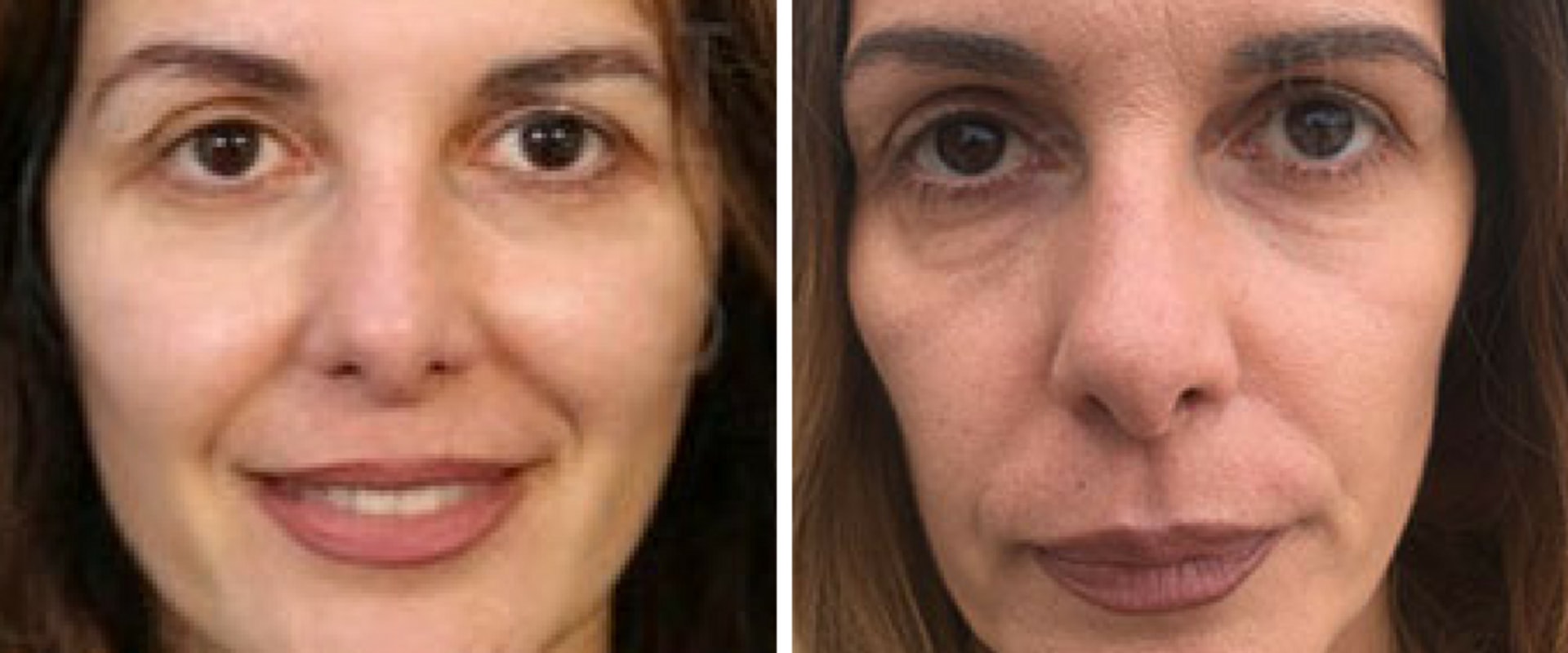Recovery Time for Surgical and Non-Surgical Cosmetic Procedures