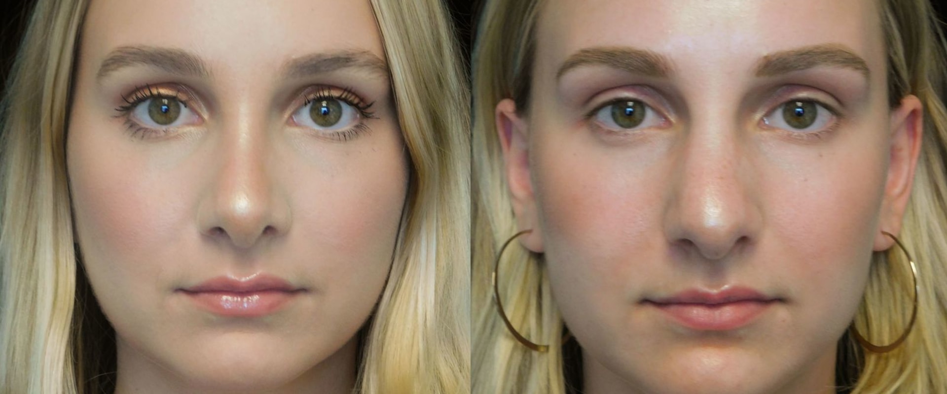 A Comprehensive Look at Rhinoplasty: Everything You Need to Know