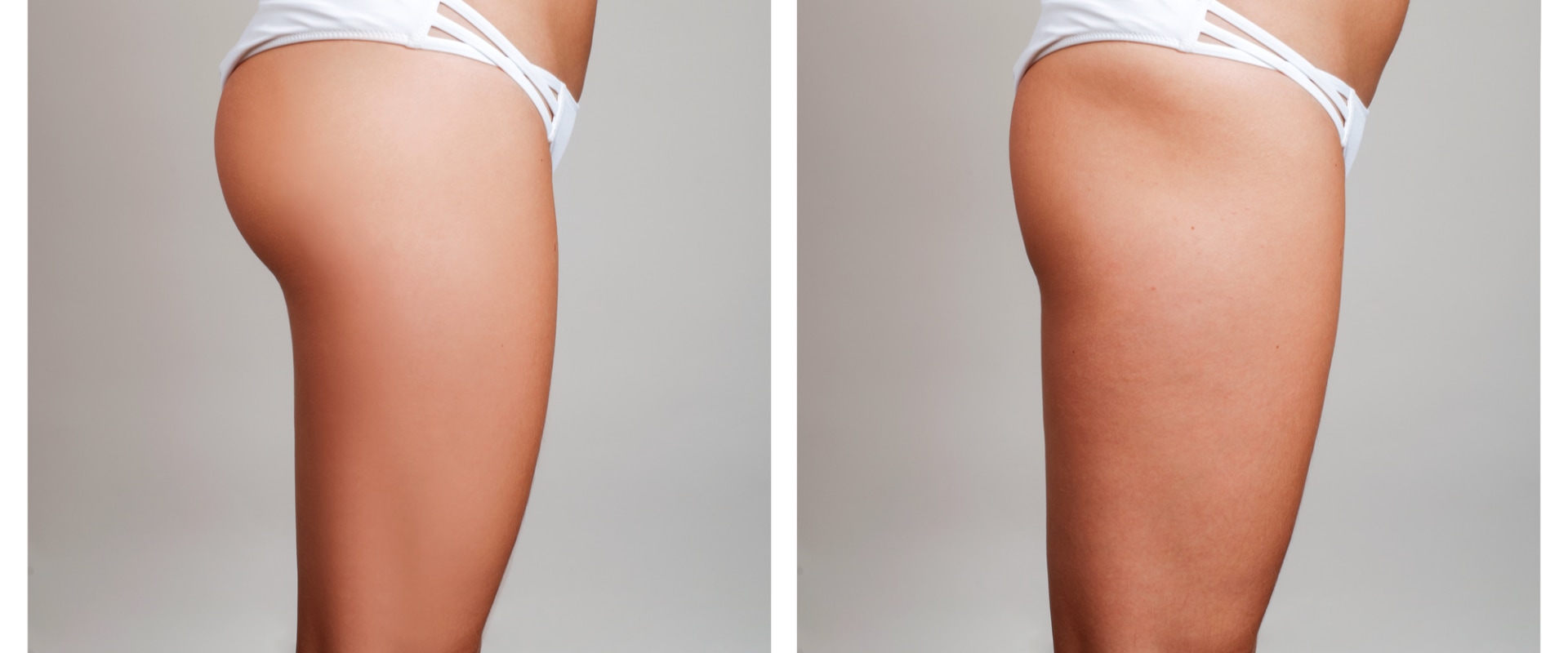 All You Need to Know About Liposuction