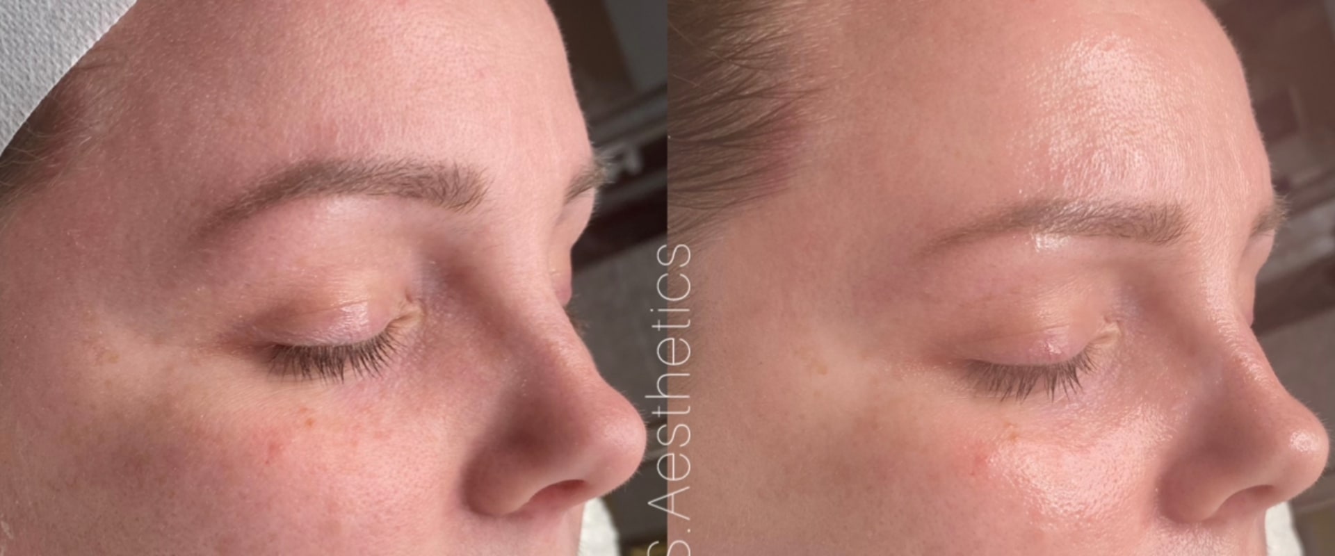 The Power of Chemical Peels for Aesthetic Enhancements