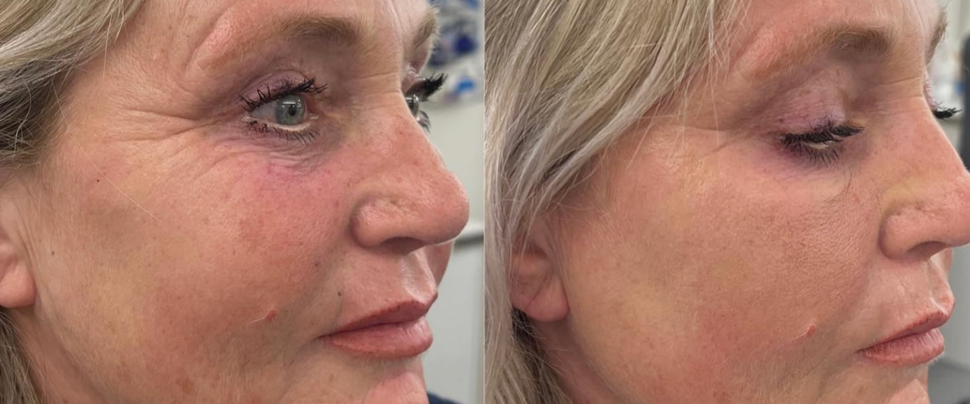 The Benefits of Dermal Fillers: Your Guide to Non-Surgical Cosmetic Procedures
