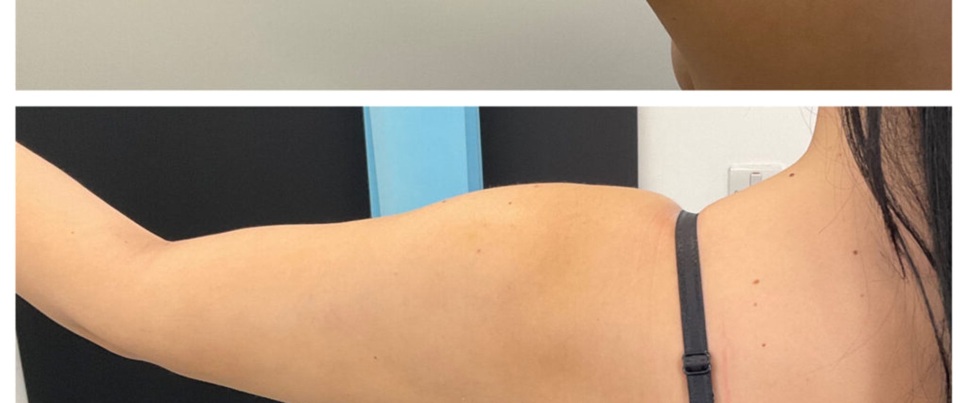 Understanding Liposuction: The Most Popular Surgical Procedure in the UK