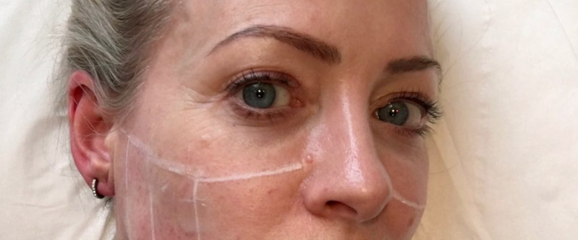 A Comprehensive Look at Ultherapy for Skin Rejuvenation in the UK