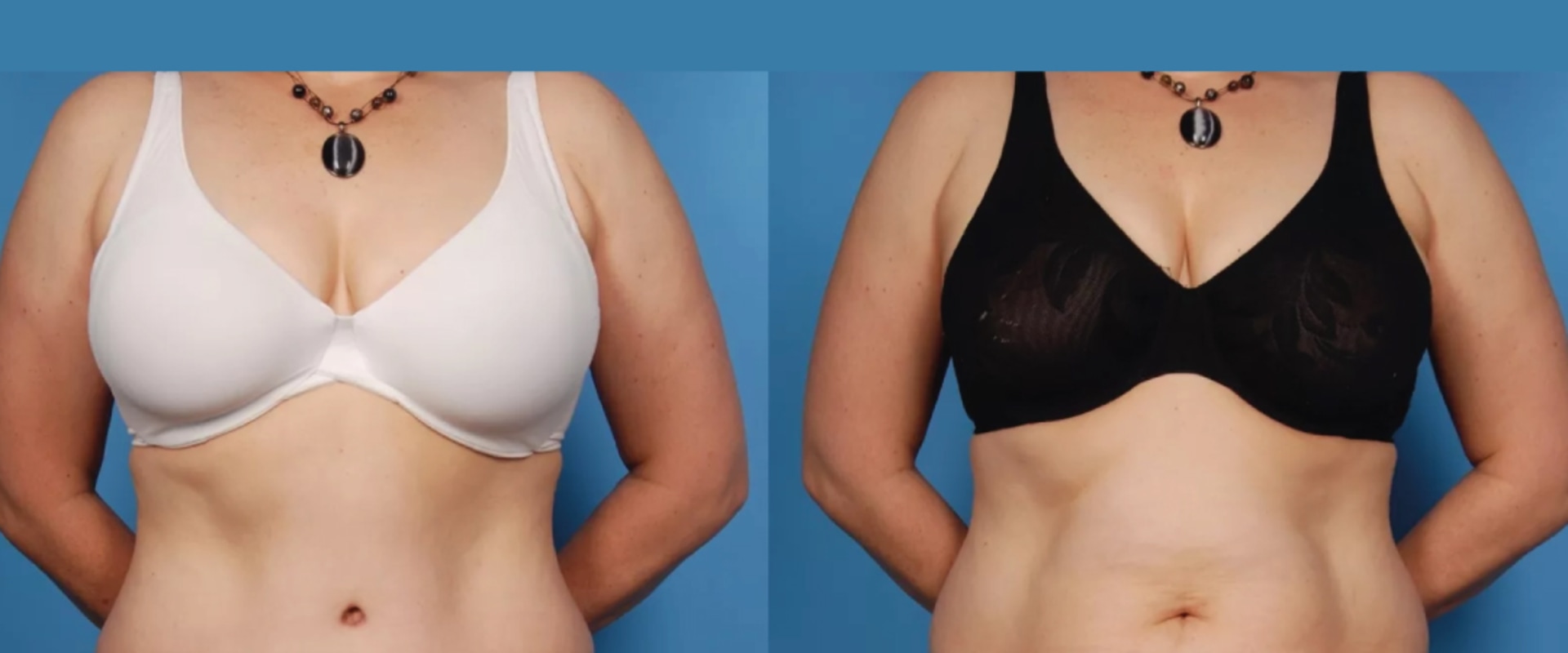 Tummy Tuck: A Popular Body Treatment for Enhancing Your Aesthetic Appearance