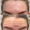A Comprehensive Look at Botox Injections for Aesthetic Enhancement