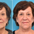 Facelift Surgery: The Ultimate Guide to Rejuvenating Your Look