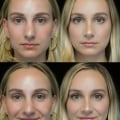 A Comprehensive Look at Rhinoplasty: Everything You Need to Know