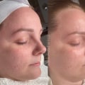 The Power of Chemical Peels for Aesthetic Enhancements