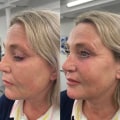 The Benefits of Dermal Fillers: Your Guide to Non-Surgical Cosmetic Procedures
