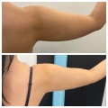 Understanding Liposuction: The Most Popular Surgical Procedure in the UK
