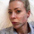 A Comprehensive Look at Ultherapy for Skin Rejuvenation in the UK