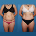 Tummy Tuck: A Popular Body Treatment for Enhancing Your Aesthetic Appearance