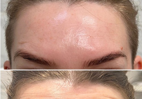 A Comprehensive Look at Botox Injections for Aesthetic Enhancement