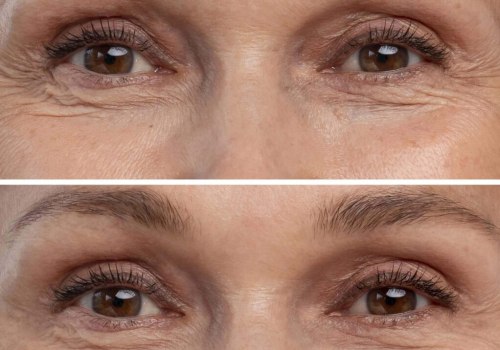 A Comprehensive Guide to Dermal Fillers: Enhance Your Facial Features