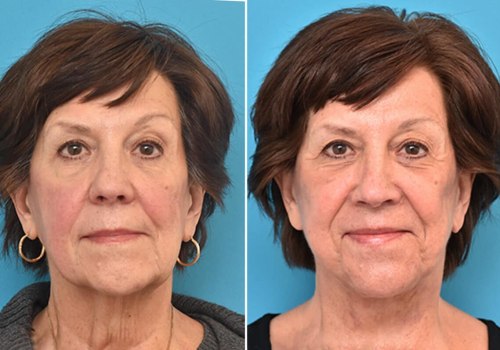 Facelift Surgery: The Ultimate Guide to Rejuvenating Your Look