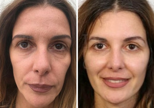 Recovery Time for Surgical and Non-Surgical Cosmetic Procedures