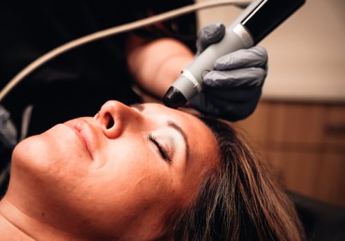 The Basics of Microneedling: A Comprehensive Guide to Popular Facial Treatments