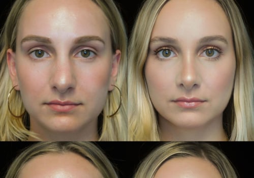 A Comprehensive Look at Rhinoplasty: Everything You Need to Know