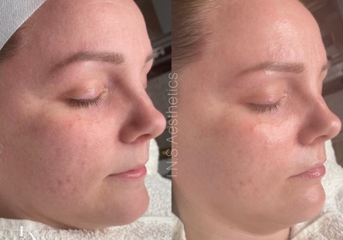 The Power of Chemical Peels for Aesthetic Enhancements