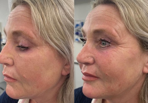 The Benefits of Dermal Fillers: Your Guide to Non-Surgical Cosmetic Procedures