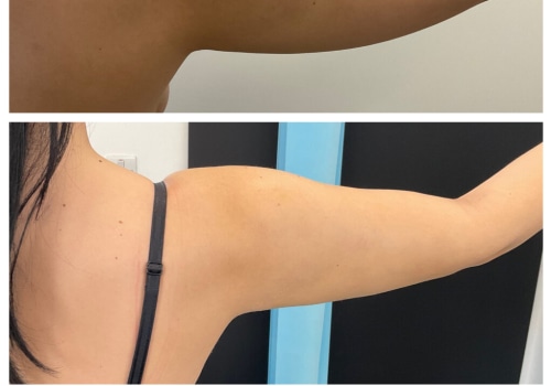 Understanding Liposuction: The Most Popular Surgical Procedure in the UK