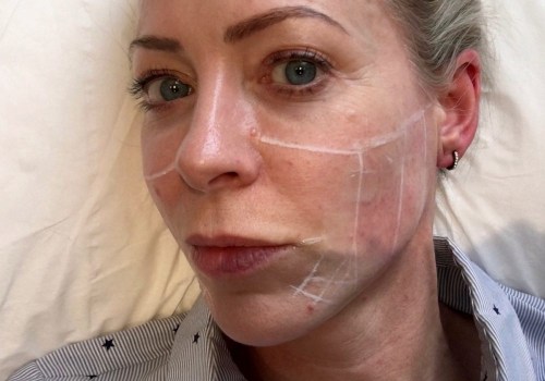 A Comprehensive Look at Ultherapy for Skin Rejuvenation in the UK
