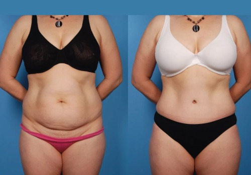 Tummy Tuck: A Popular Body Treatment for Enhancing Your Aesthetic Appearance